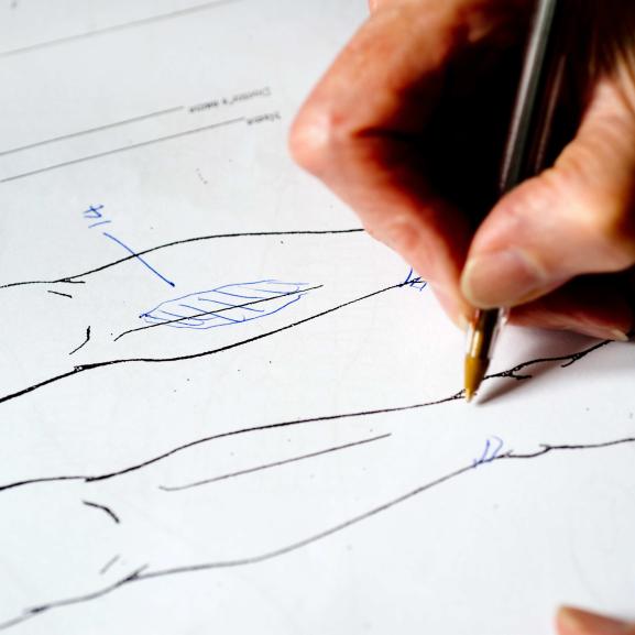 A medico-legal report diagram documenting scars from torture on a person's leg