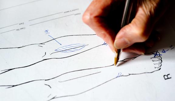 A medico-legal report diagram documenting scars from torture on a person's leg